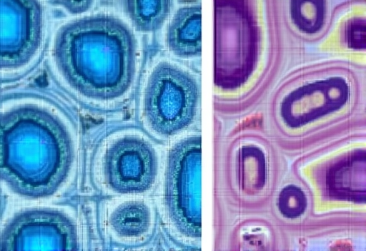 Microscopic view of cancer cells showing abnormal structure and division patterns compared to normal cells